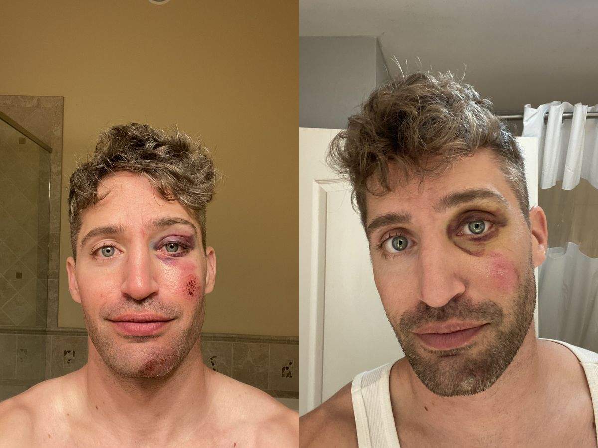 herobust snowboarding accident pictures